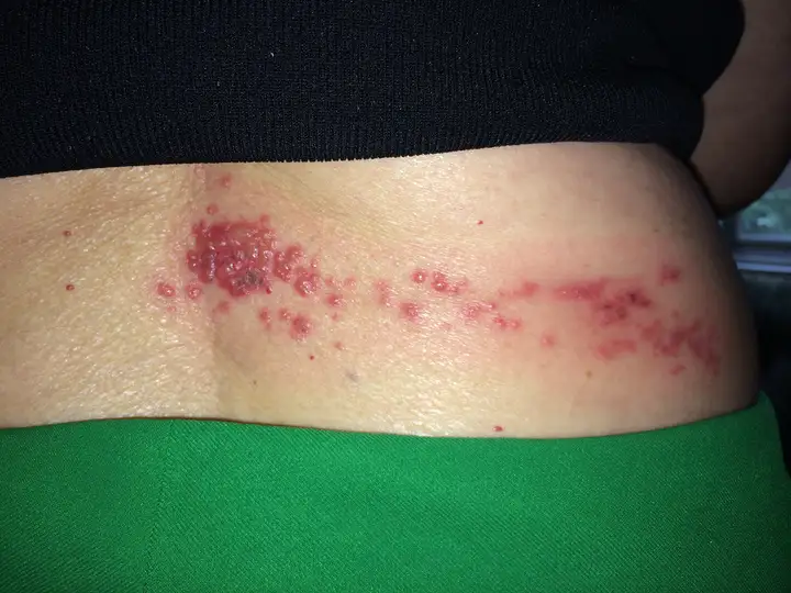 Dual-action therapy for viral lesions and skin repair