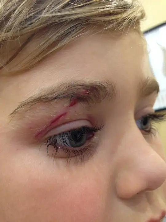 Fast, gentle relief for styes around the eye