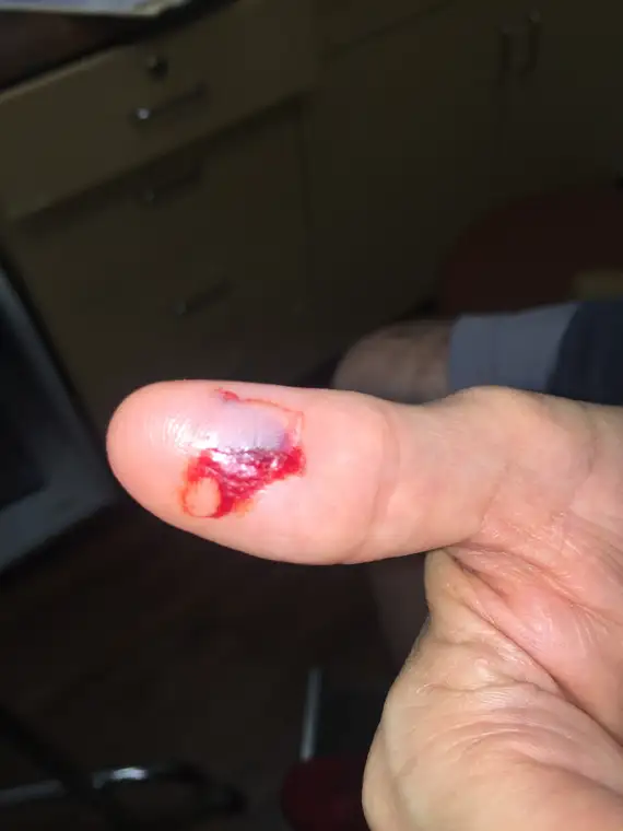 Gorilla Skin on thumbs