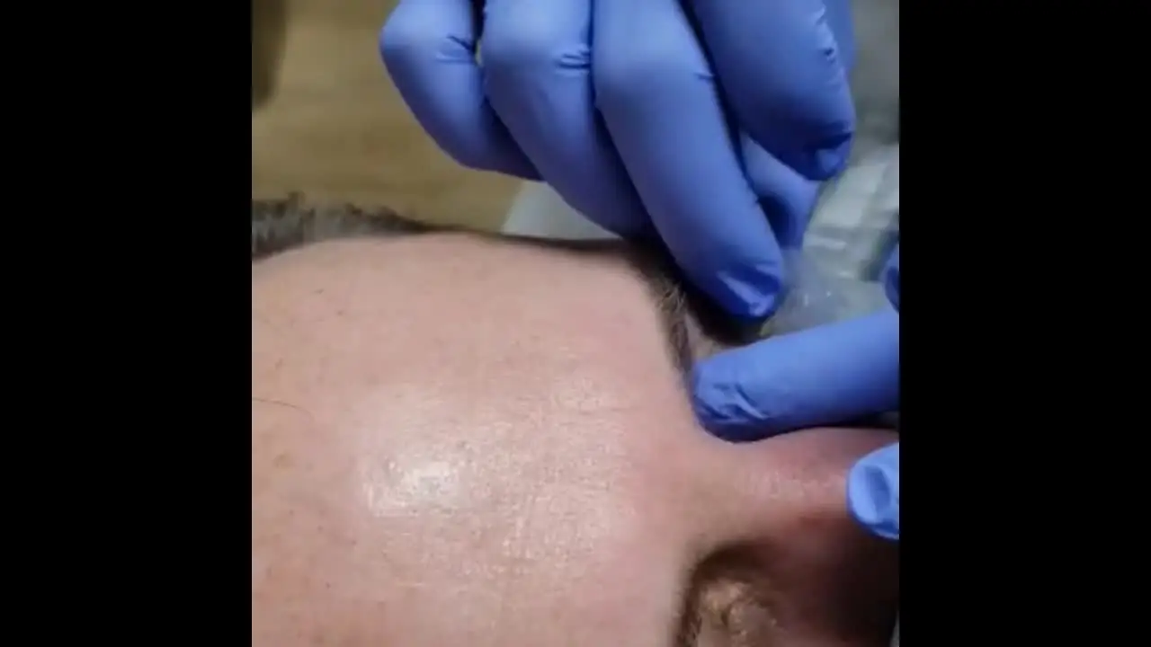 Poster frame: Application along facial contours
