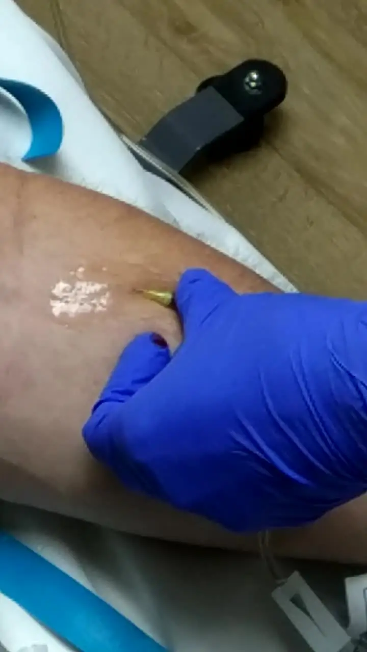 Poster frame: Sealing around an IV site