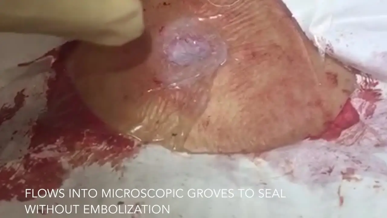 Poster frame: Seal and lift-out on an open wound